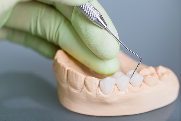 Dental Crowns