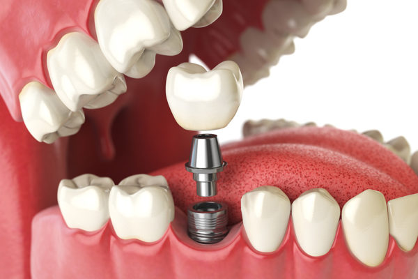 Dental Implant Surgeries