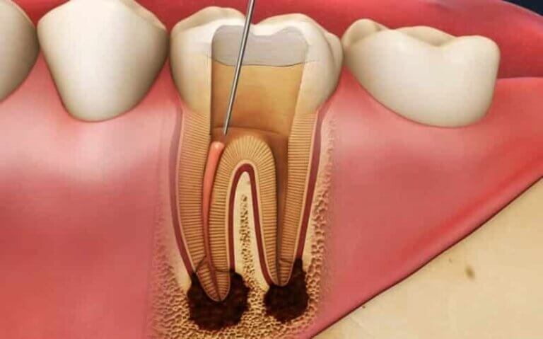 Failed Root Canal