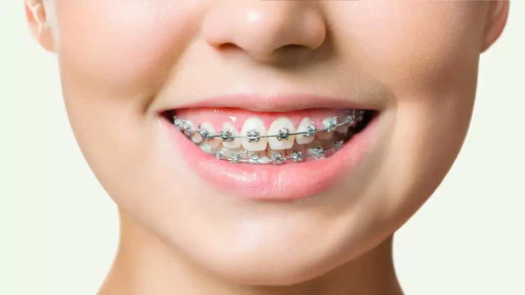 How Much Can Invisalign Cost?
