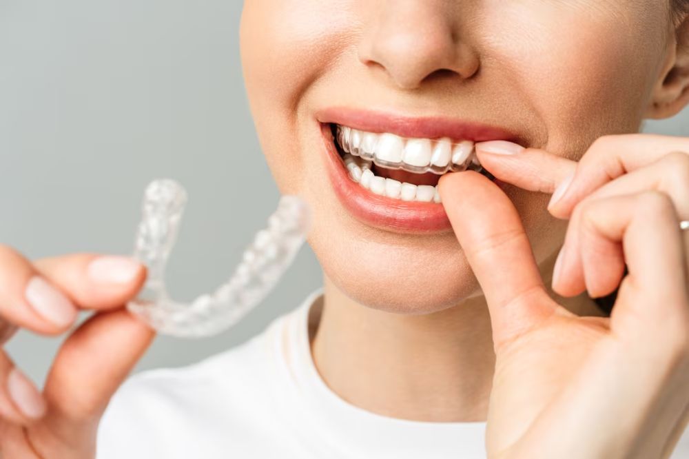 Step-by-step Invisalign journey: from consultation to perfect smile