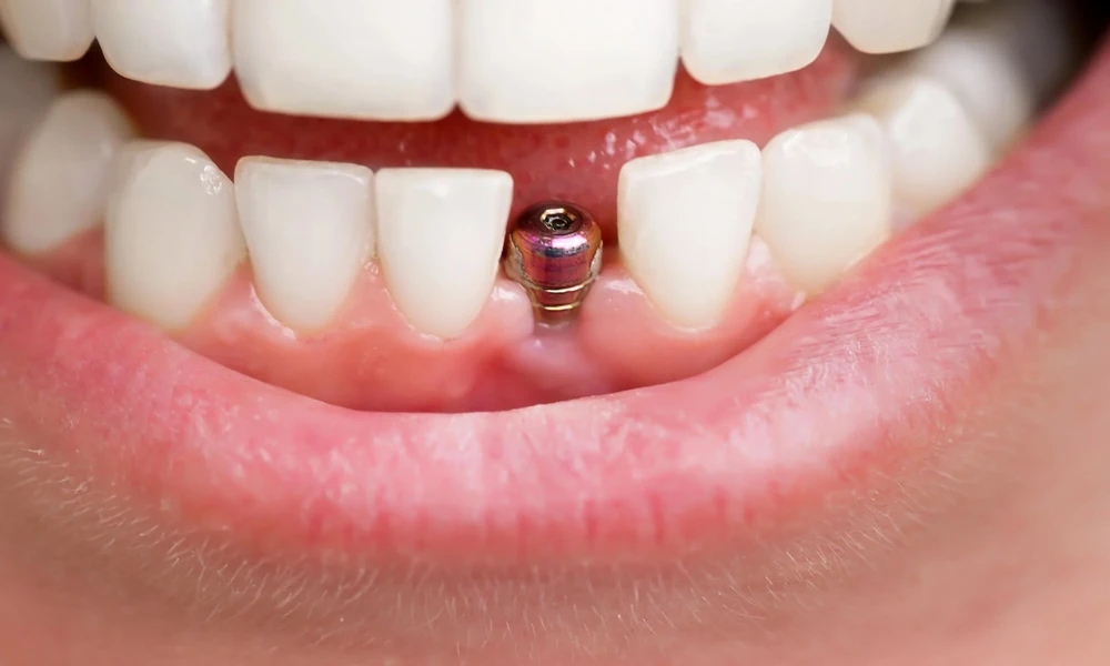 5 Factors That Influence How Natural Your Dental Implants Look