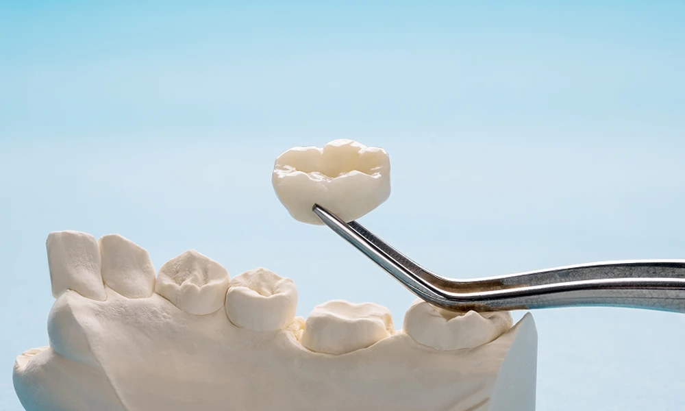 4 Situations Where a Dental Crown May Be Recommended Instead of a Filling