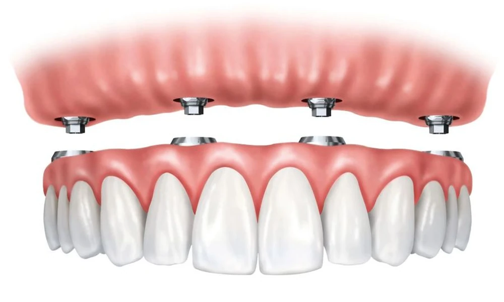 FULL MOUTH DENTAL IMPLANT COSTS: A COMPLETE GUIDE