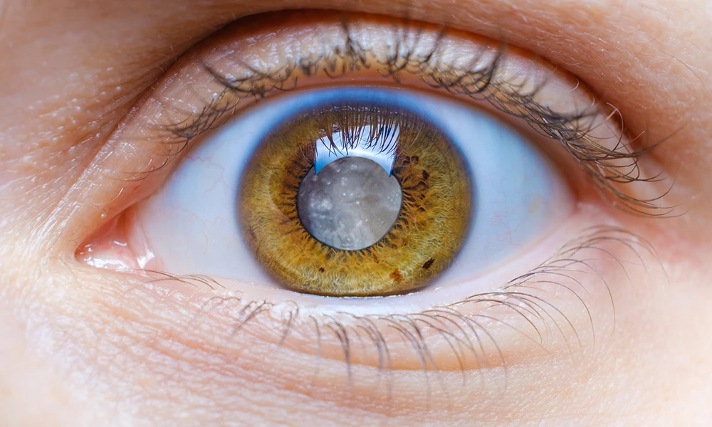 WHY VISION GETS CLOUDY OVER TIME AND WHAT IT MEANS