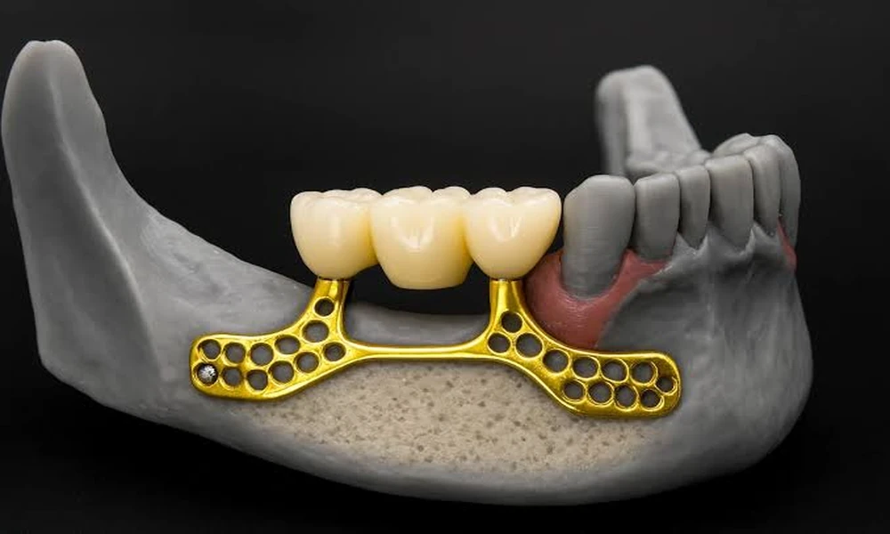 What Are the 3 Types of Dental Implants? Endosteal, Subperiosteal, and Zygomatic Explained
